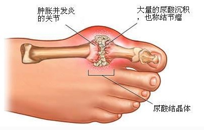 痛风急性发作期用药分析
