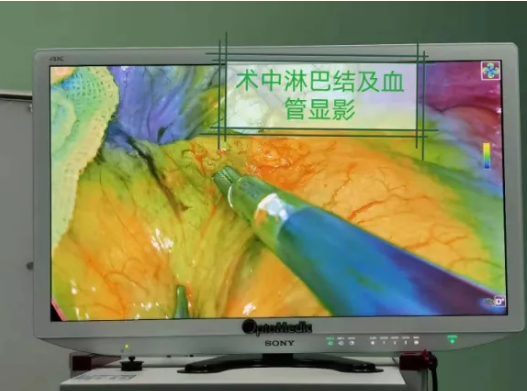 红河州第三人民医院成功开展荧光腹腔镜胃癌根治术