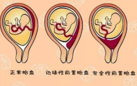 【医疗传真】高龄二胎产妇遇完全性前置胎盘 红河州第三人民医院保母婴平安
