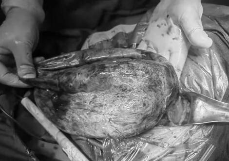 22周孕妈妈查出卵巢囊肿蒂扭转！红河州第三人民医院专家巧手保母婴平安