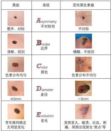 识“黑”宜早 除“恶”务尽：警惕恶性黑色素瘤危及生命健康